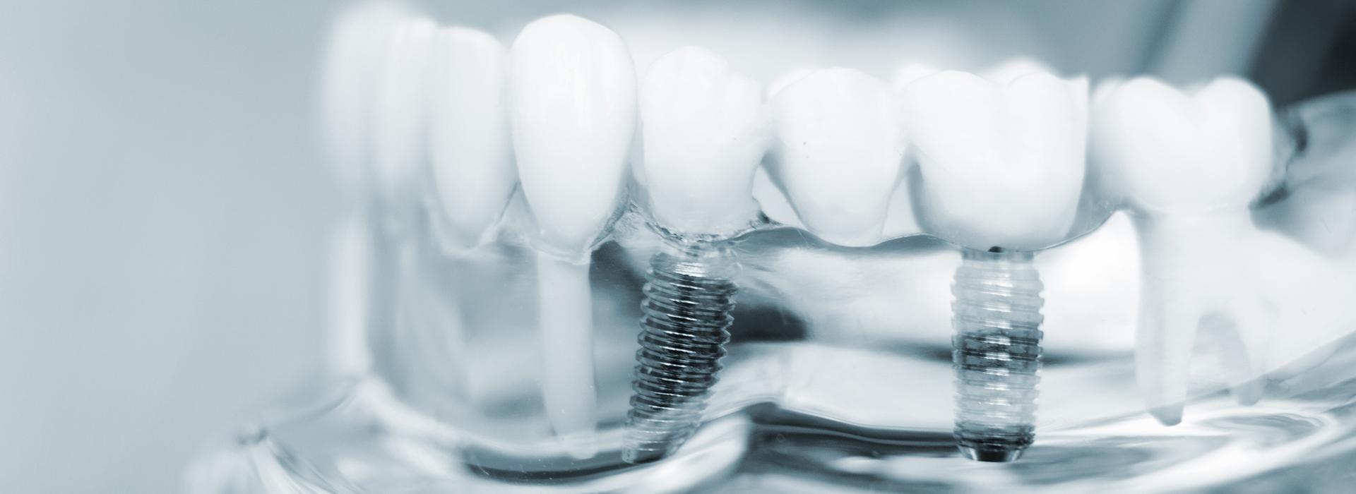Dental Implants in Orange